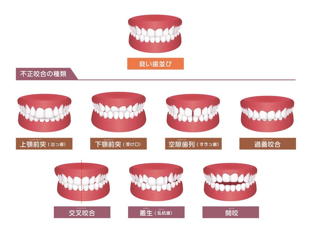 咬み合わせとは