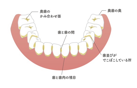 歯垢が溜まりやすい場所